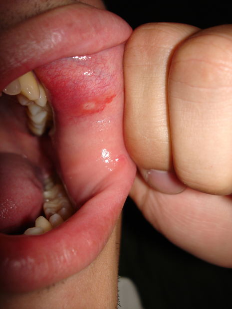 mouth ulcers