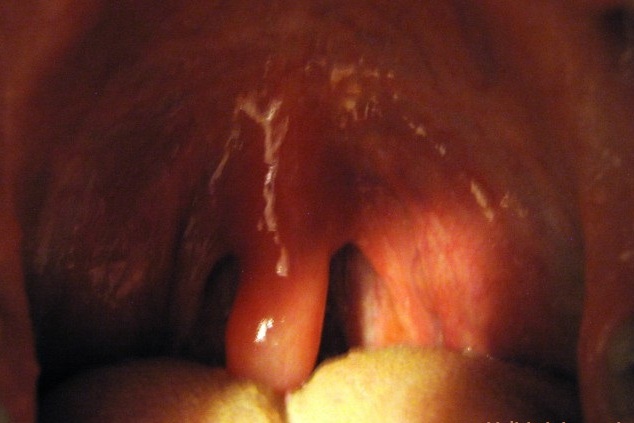 Uvulitis: Inflamed, Swollen and Elongated Uvula