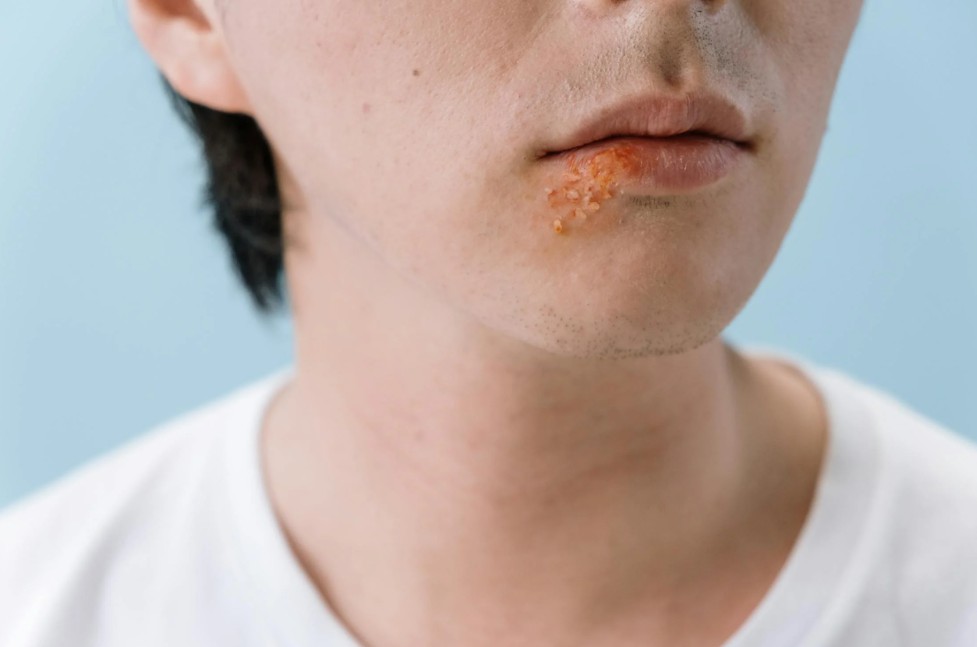 Natural Remedies for Cold Sores